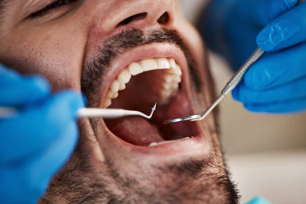 Best Chipped Tooth Repair Near Me  in Monterey, TN