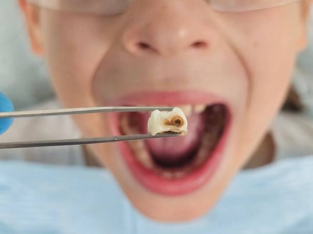 Best Knocked-Out Tooth Emergency  in Monterey, TN
